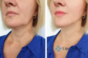 Double chin before and after Hi-Fu treatment 4 Book your double chin treatment Leeds today! We are here to help!