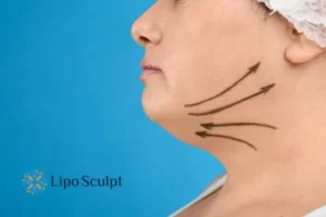 Double chin before and after Hi-Fu treatment 3 Boost your confidence with a Double chin treatment Leeds