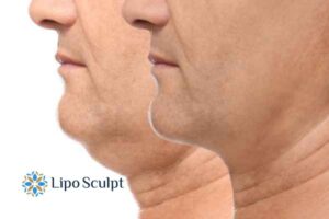 Double chin before and after Hi-Fu treatment 2 Double chin treatment Leeds from Lipo Sculpt - feel more confident today!