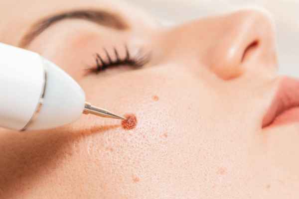 CryoPen: 5 Skin Concerns It May Be Used to Treat 3 What actually happens during a CryoPen treatment Leeds?