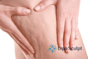 CoolSculpting for Legs: The Innovative Approach to Redefining Your Legs 5 Start your journey today book your coolsculpting treatment Leeds online today!