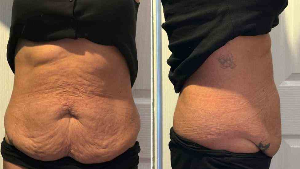 Lost the Weight but Not the Loose Skin? What You Should Know 1 Is It Definitely Loose Skin Leeds?